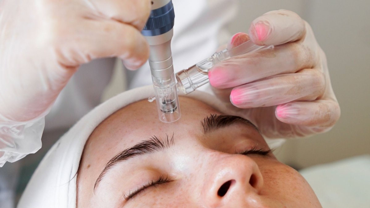 Microneedling - Here's What you Need to Know - Beauty Pro Supplies Canada
