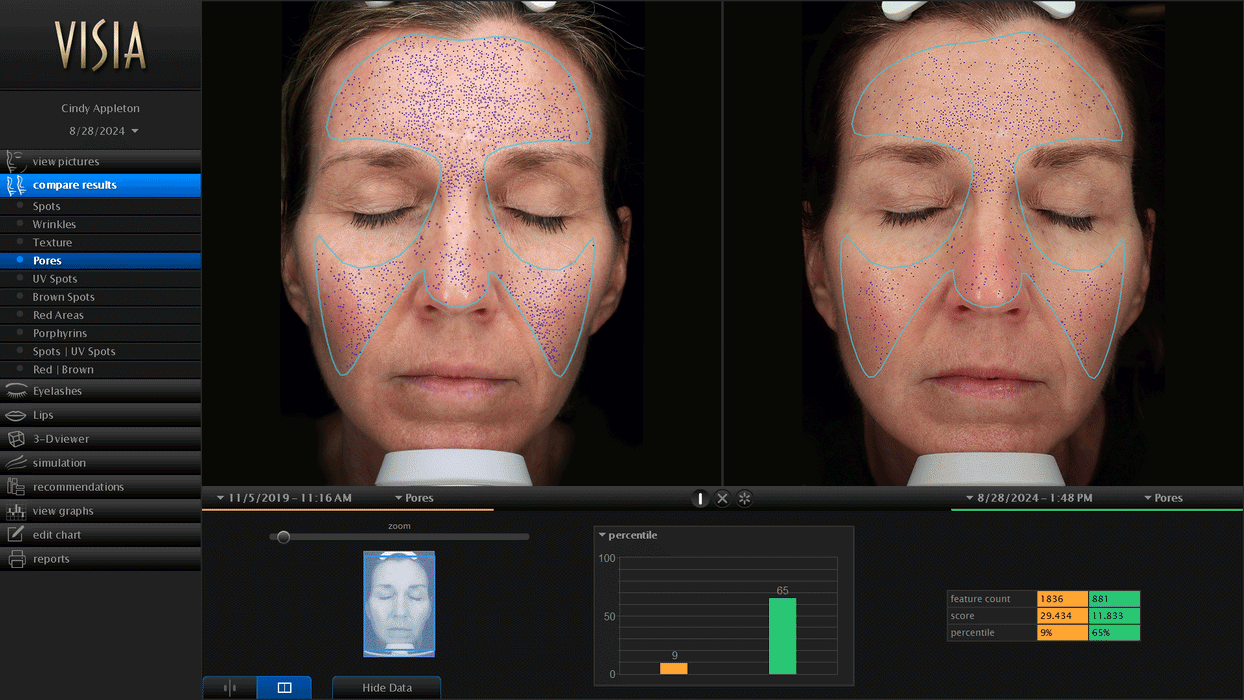 Visia Skin Analysis System Generation 7, Pre-Owned / Used