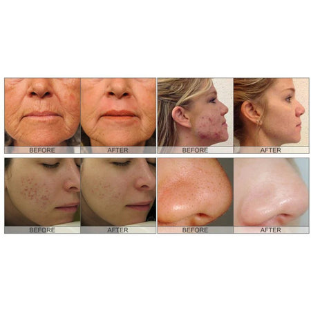 Advanced Hydro Dermabrasion Facial Machine, Model X13D