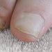 LCN Ingrown Toenail Brace B/S Bracing System, Size 18