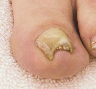 LCN Ingrown Toenail Brace B/S Bracing System, Size 18