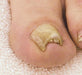 LCN Ingrown Toenail Brace B/S Bracing System, Size 18