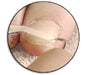 LCN Ingrown Toenail BS Brace System, Size 18