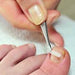 LCN Ingrown Toenail BS Brace System, Size 18
