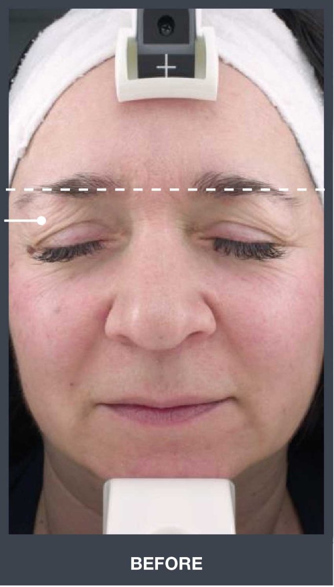 Silhouet Tone RMD Structural Remodelling Unit - Skin Tightening and Lifting Effect for Face + Neck
