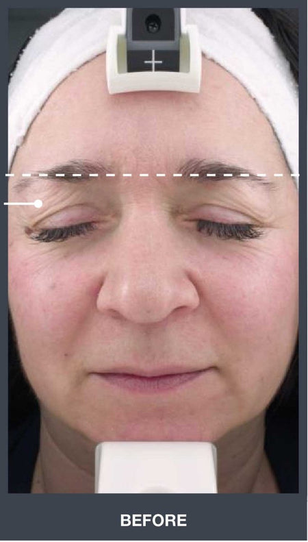 Silhouet Tone RMD Structural Remodelling Unit - Skin Tightening and Lifting Effect for Face + Neck