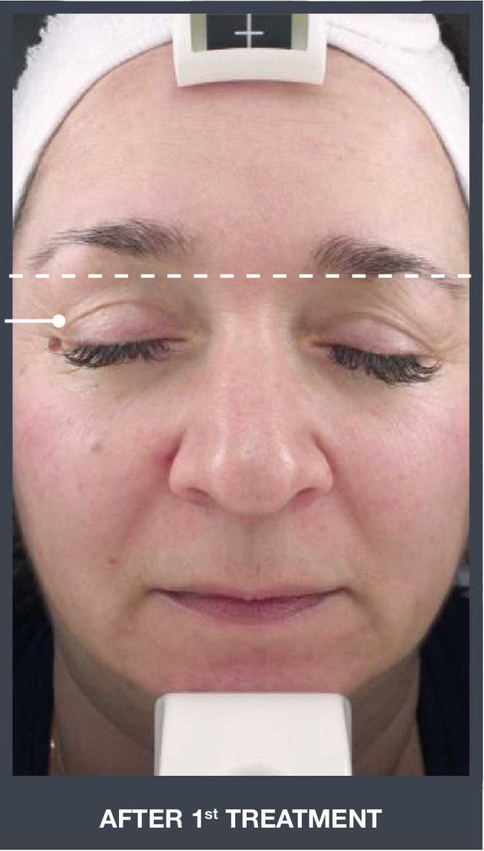 Silhouet Tone RMD Structural Remodelling Unit - Skin Tightening and Lifting Effect for Face + Neck