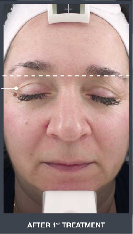 Silhouet Tone RMD Structural Remodelling Unit - Skin Tightening and Lifting Effect for Face + Neck