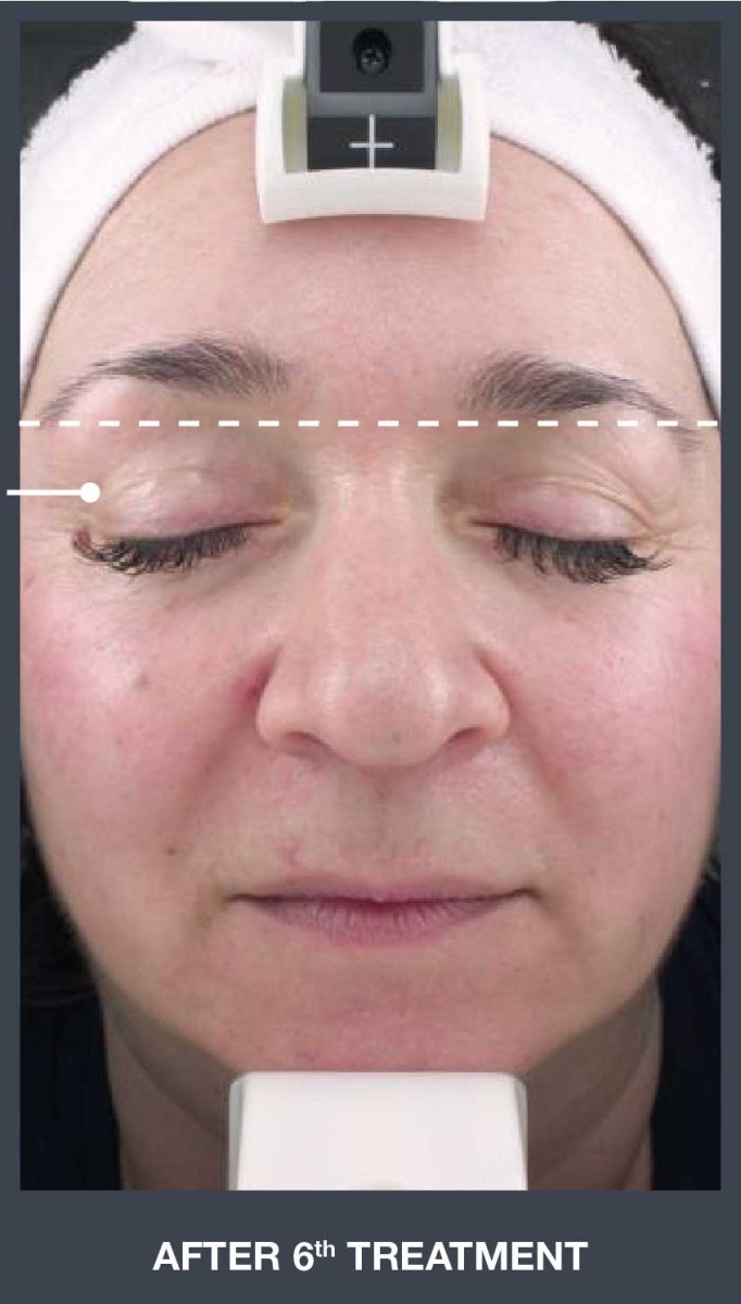 Silhouet Tone RMD Structural Remodelling Unit - Skin Tightening and Lifting Effect for Face + Neck