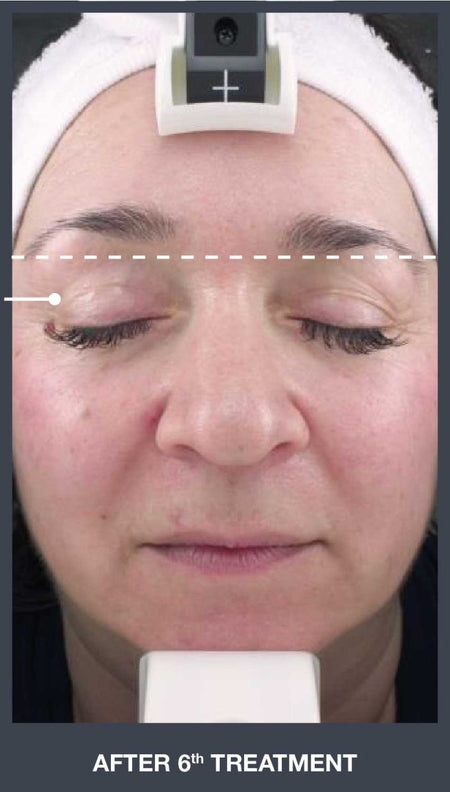 Silhouet Tone RMD Structural Remodelling Unit - Skin Tightening and Lifting Effect for Face + Neck